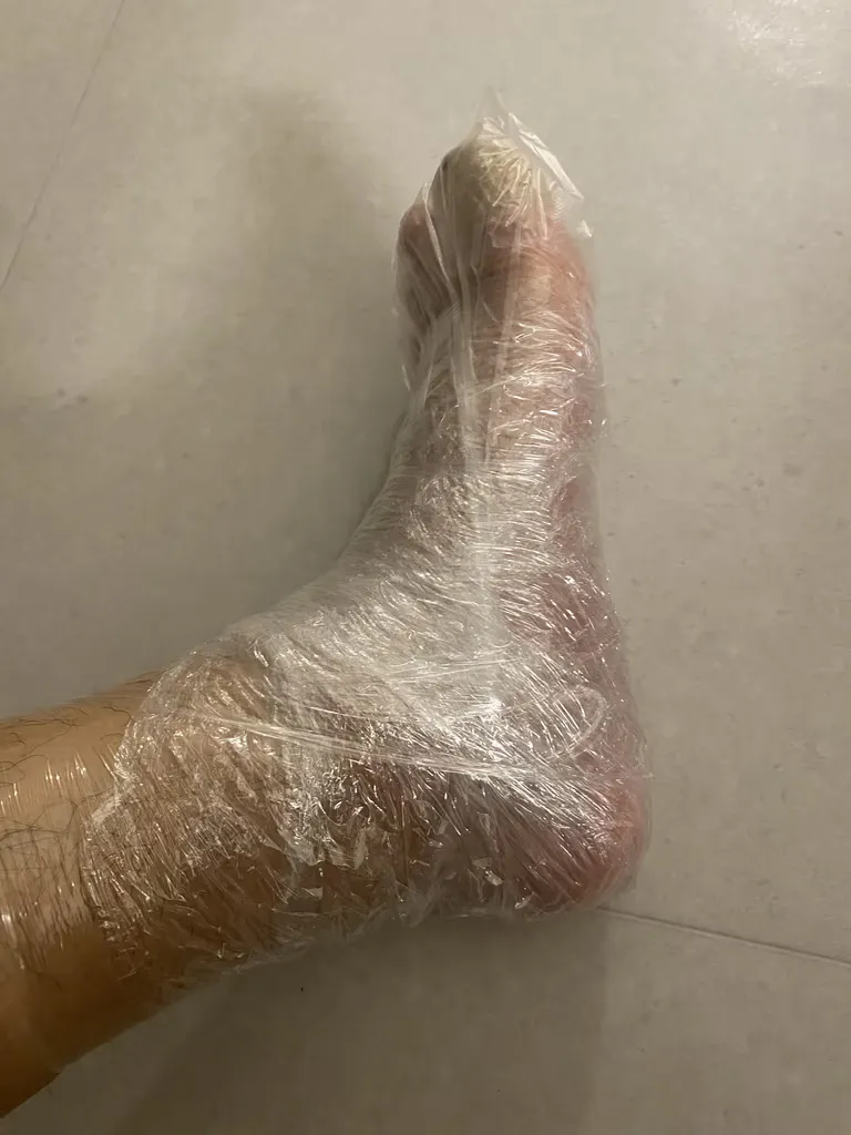 발가락 결절종 수술 후기, 수술 상처 관리 방법-9