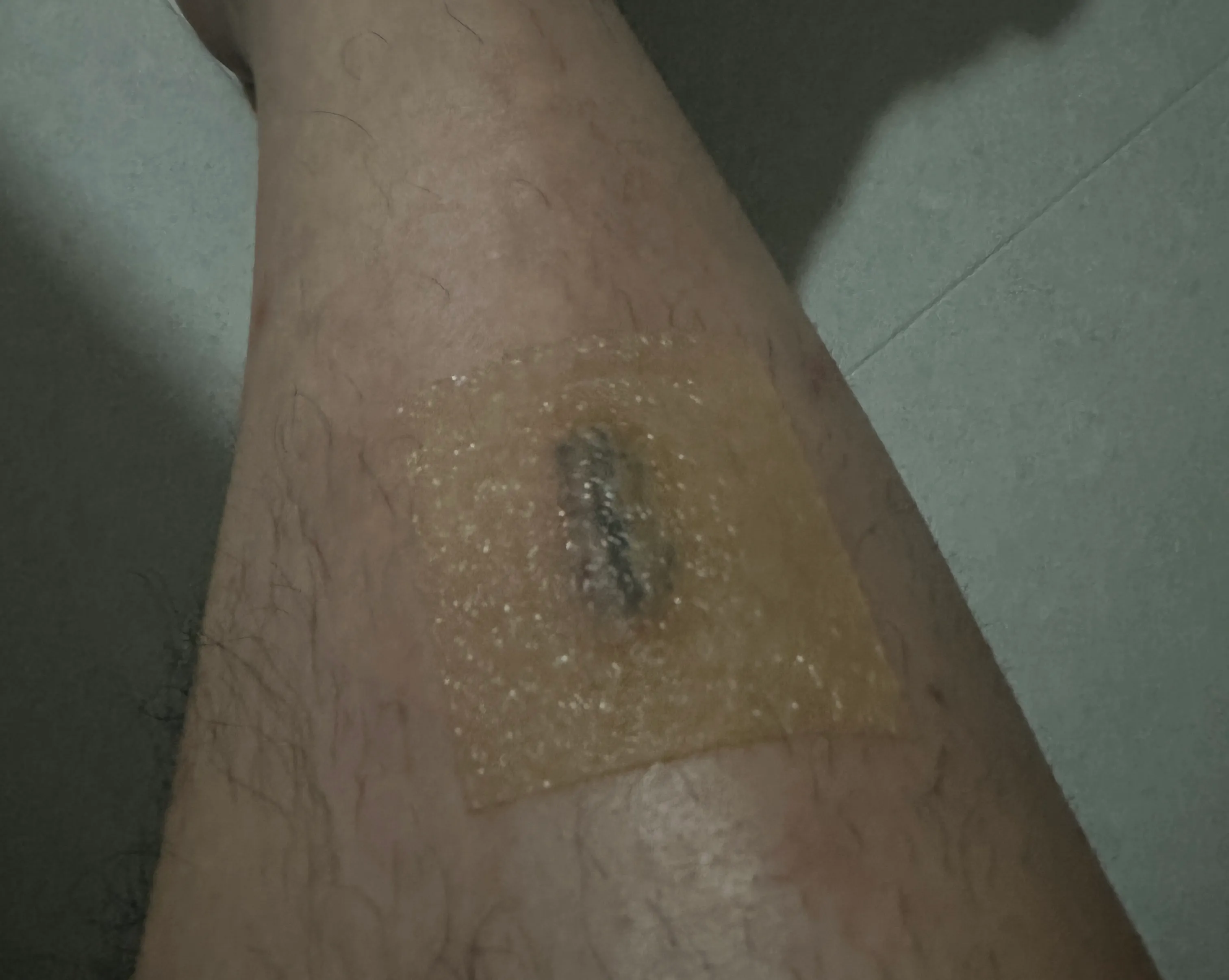 상계 백병원 응급실 후기 - 상처 꿰매는 기준, 드레싱 방법, 꿰맨 상처 회복 기간-19